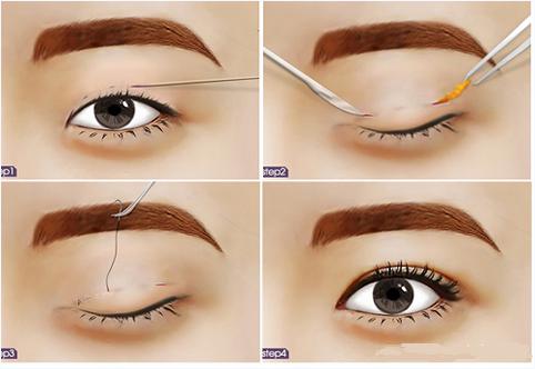 Quy trình nhấn mí diễn ra vô cùng đơn giản và nhanh chóng
