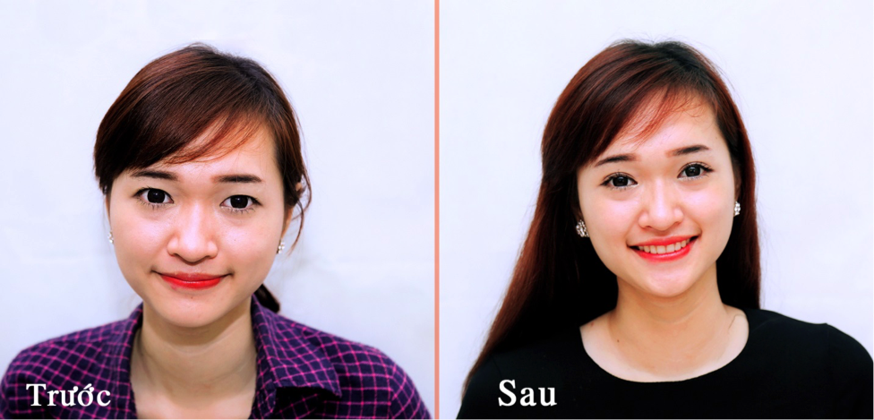 Phương pháp nhấn mí hàn quốc có rất nhiều ưu điểm