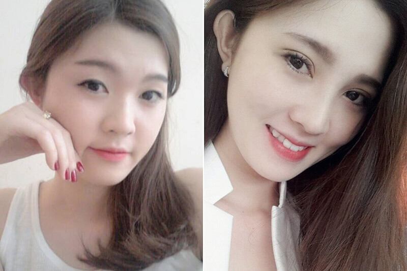 Nhấn mí là phương pháp thẩm mỹ không xâm lấn, không gây đau đớn và rất an toàn