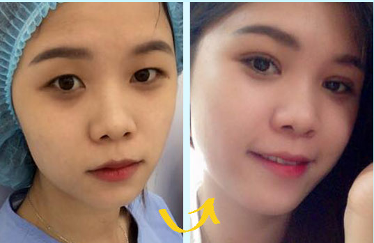 Nhấn mí vĩnh viễn đang được rất nhiều chị em yêu thích
